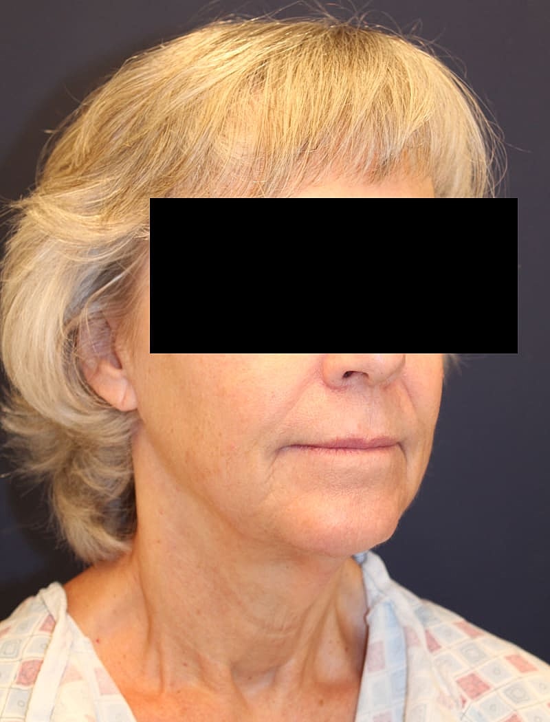 Neck Lift Gallery Before & After