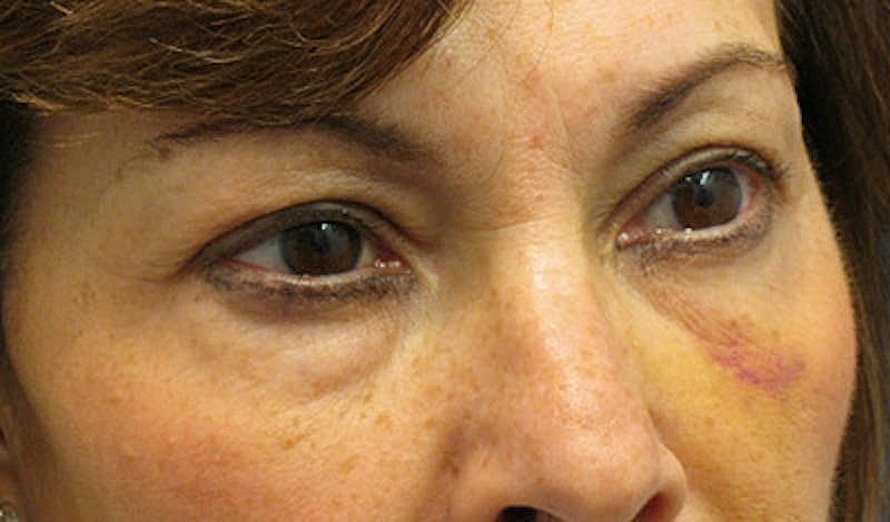 Brow Lift Before & After