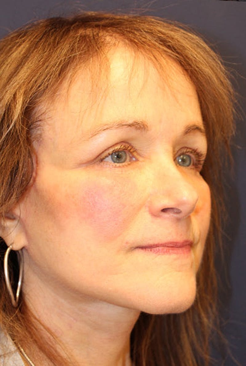 Brow Lift Before & After