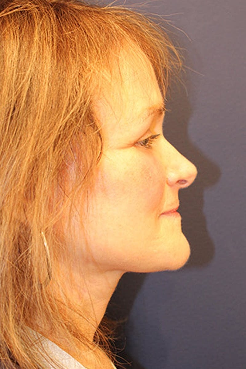 Brow Lift Before & After