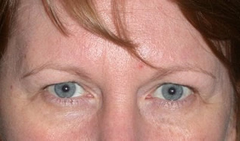 Brow Lift Before & After