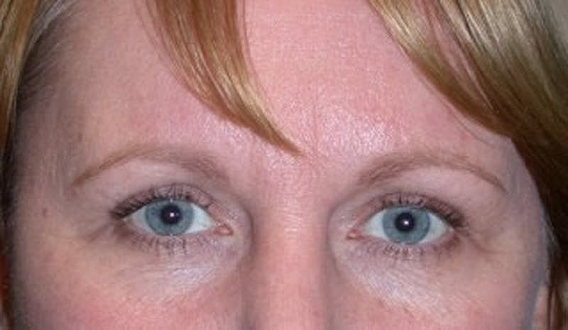 Brow Lift Before & After