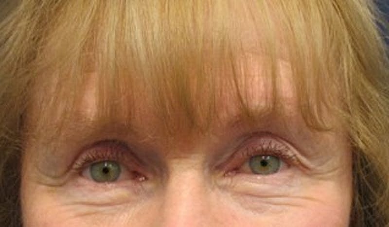 Brow Lift Before & After
