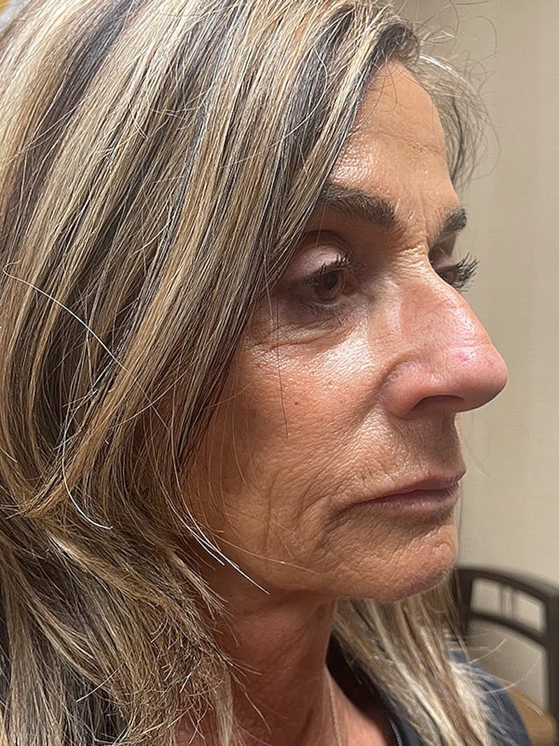 Injectables Before & After