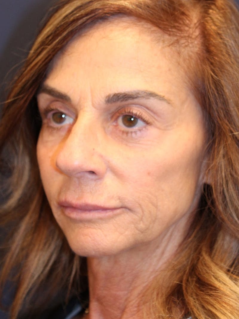 Injectables Before & After