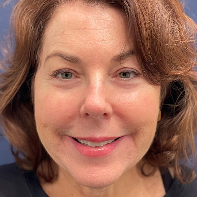 Injectables Before & After