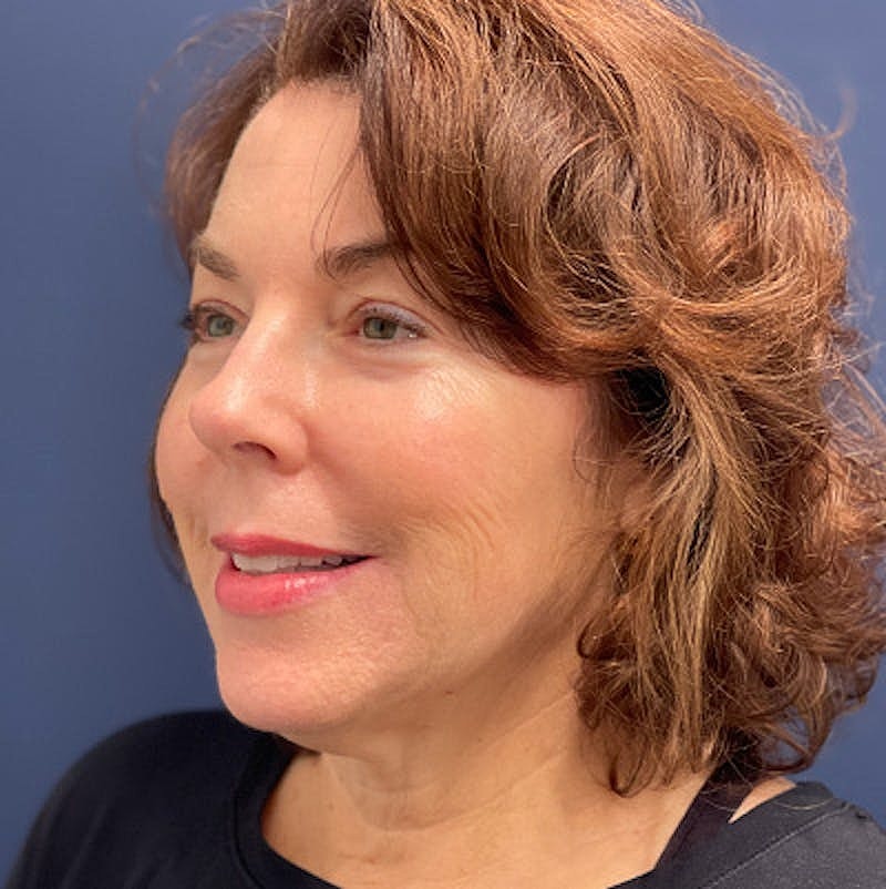 Injectables Before & After