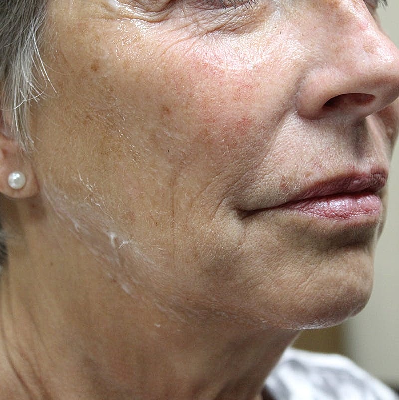 Injectables Before & After