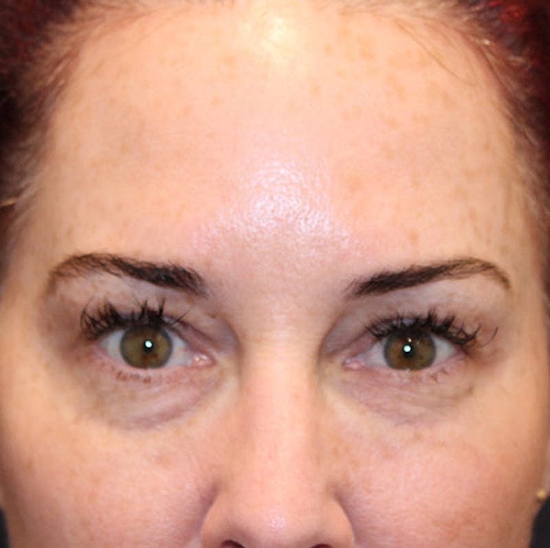 Injectables Before & After