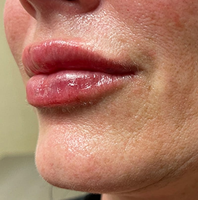 Injectables Before & After