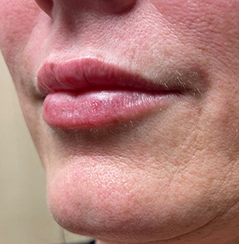 Injectables Before & After