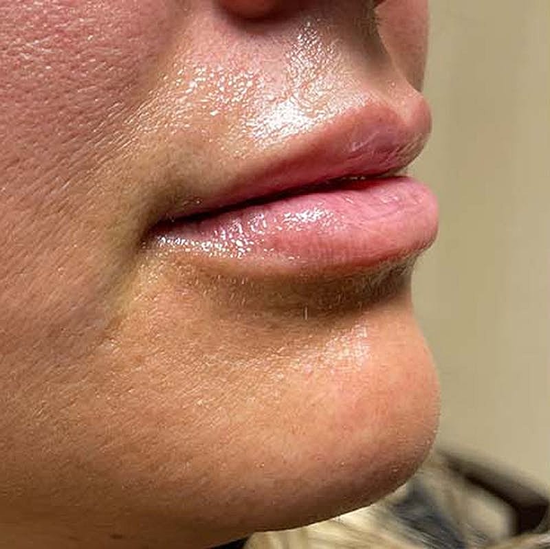 Injectables Before & After