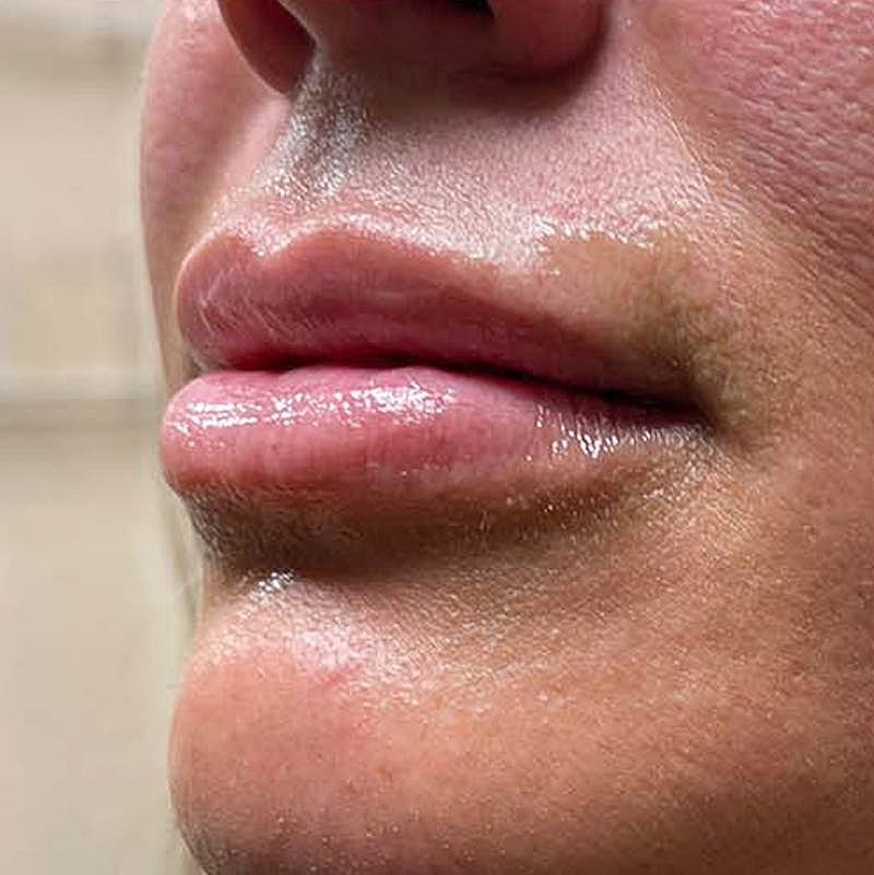 Injectables Before & After