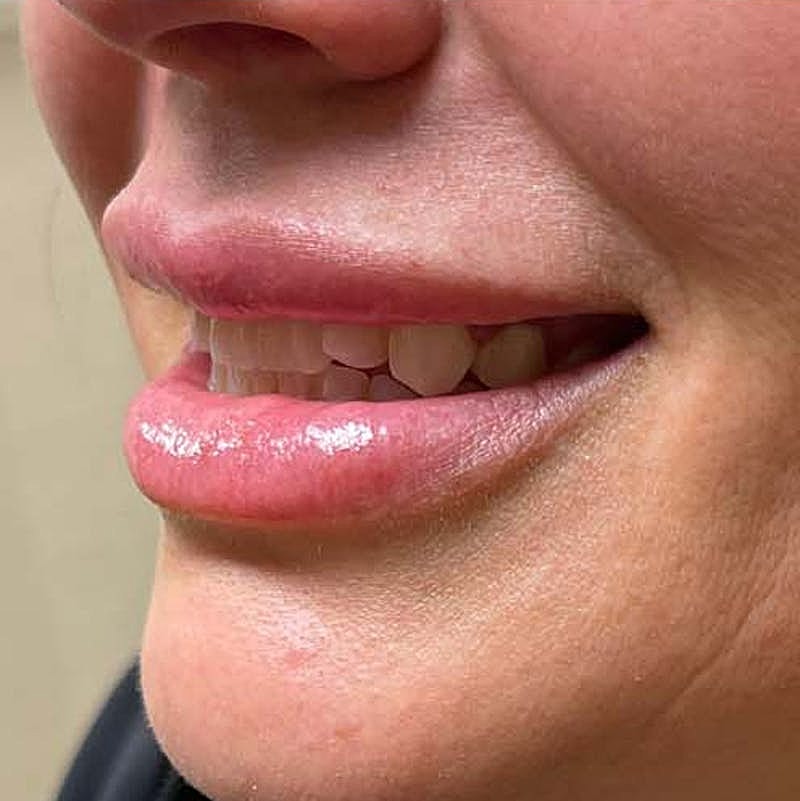 Injectables Before & After