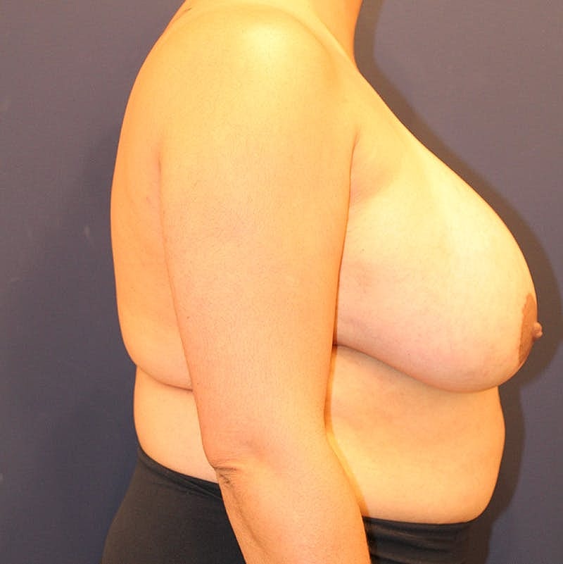 Breast Lift With Augmentation Before & After