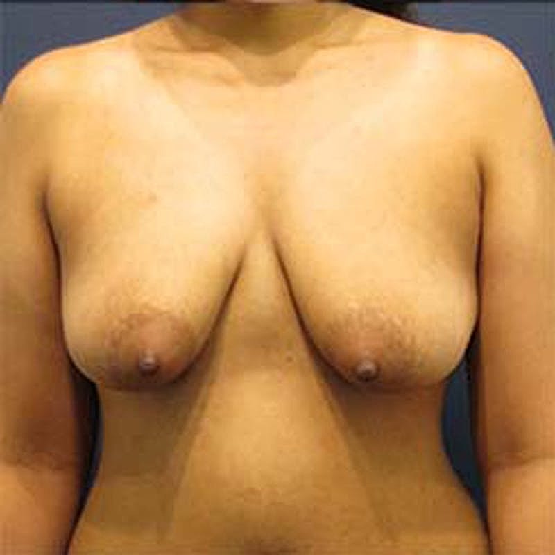 Breast Lift With Augmentation Before & After