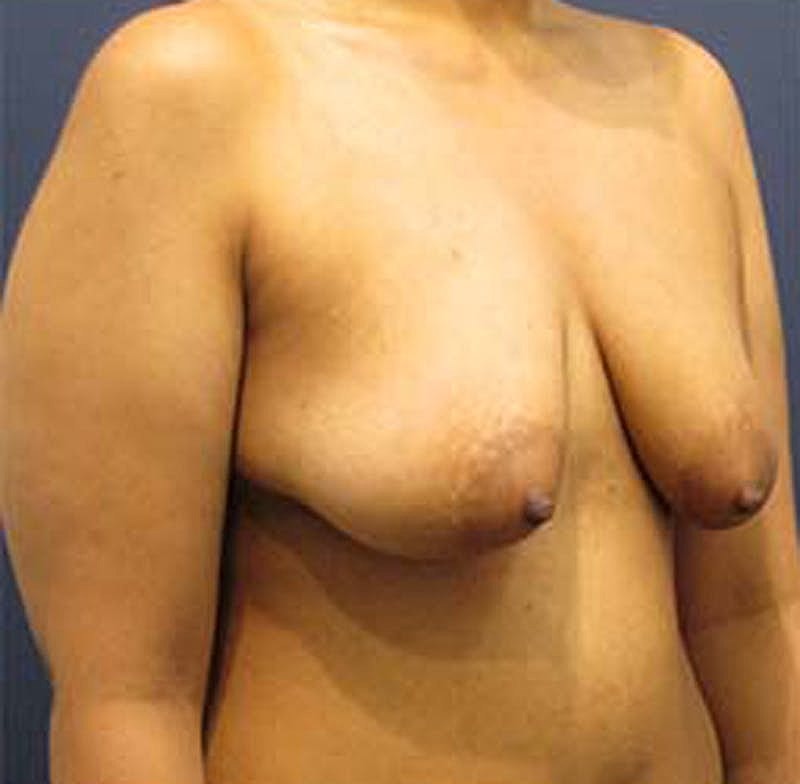 Breast Lift With Augmentation Before & After