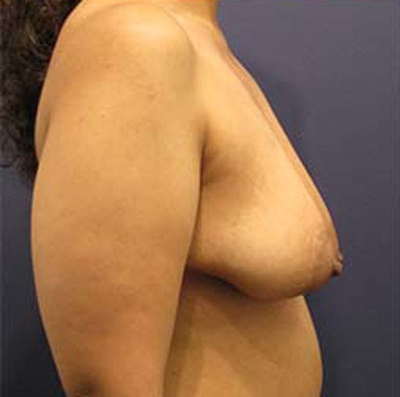 Breast Lift With Augmentation Before & After