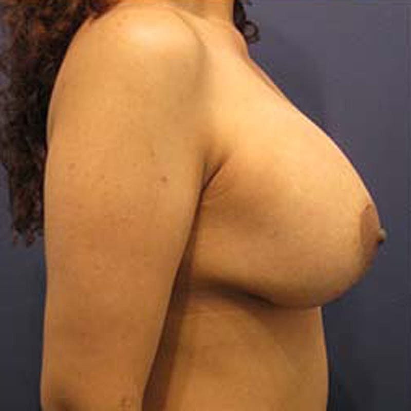 Breast Lift With Augmentation Before & After
