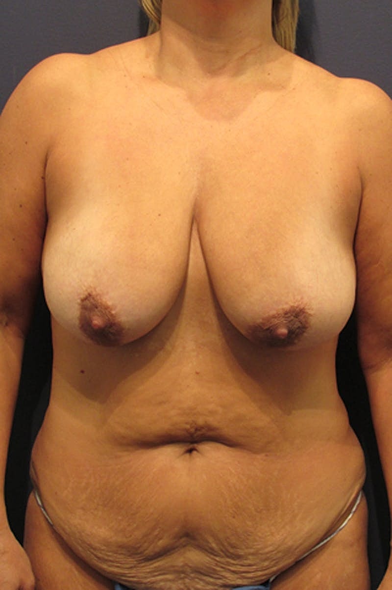 Breast Lift With Augmentation Before & After
