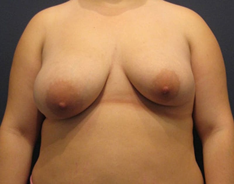 Breast Lift With Augmentation Before & After