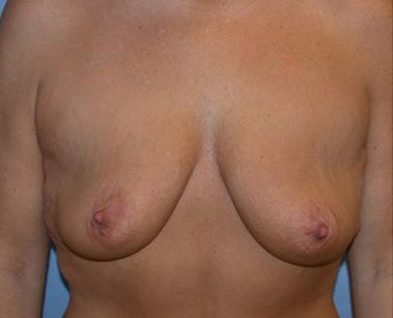 Breast Lift With Augmentation Before & After