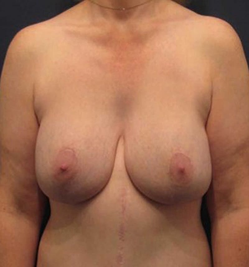 Breast Lift With Augmentation Before & After