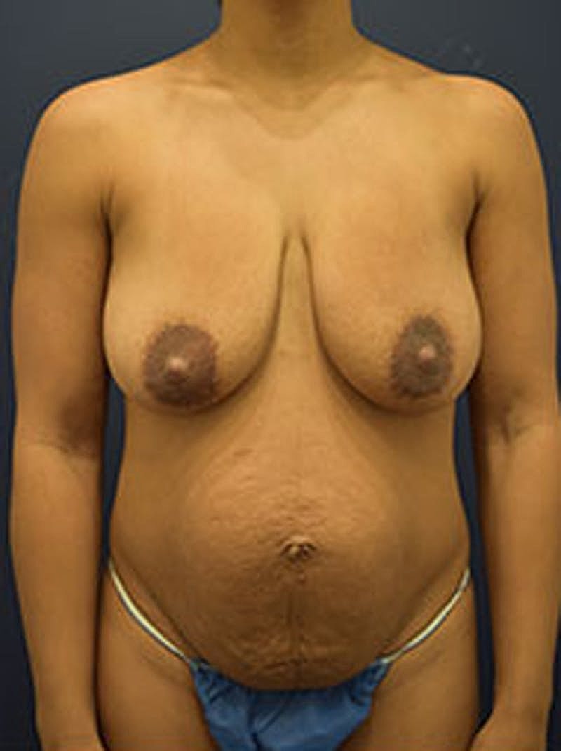 Breast Lift With Augmentation Before & After