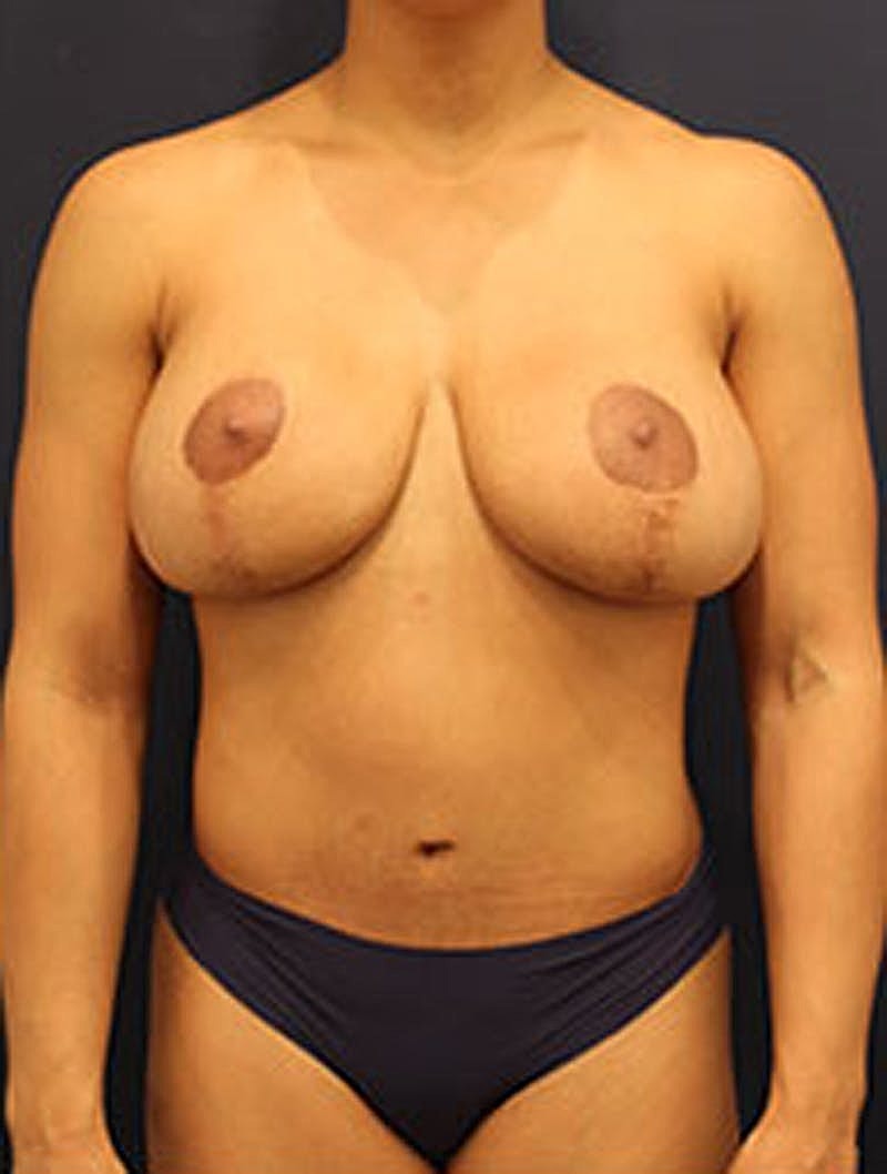 Breast Lift With Augmentation Before & After