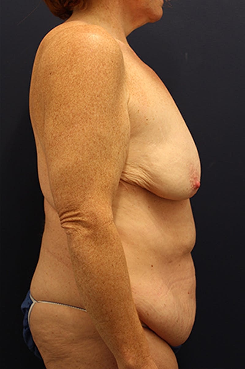 Breast Lift With Augmentation Before & After