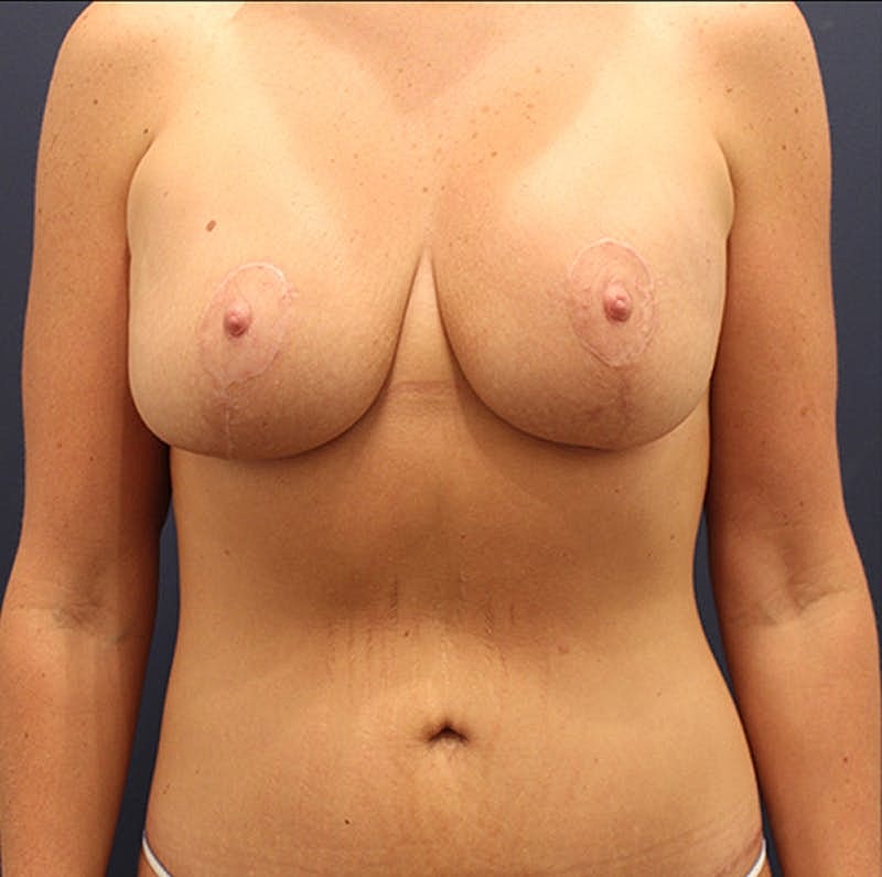 Breast Lift With Augmentation Before & After