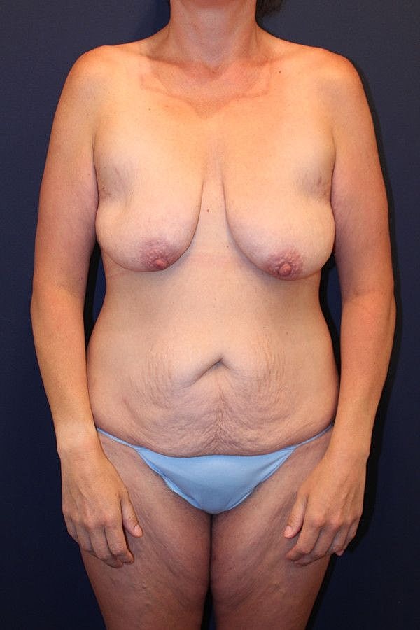 Breast Lift With Augmentation Gallery Before & After