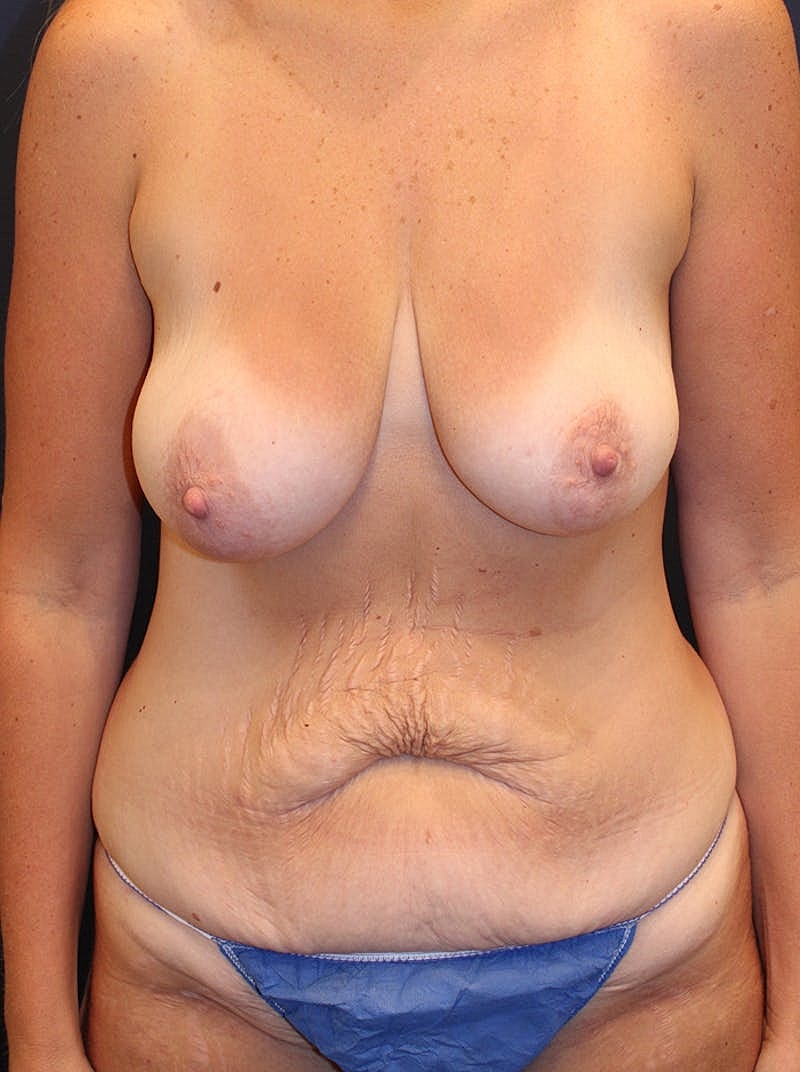 Mommy Makeover Before & After