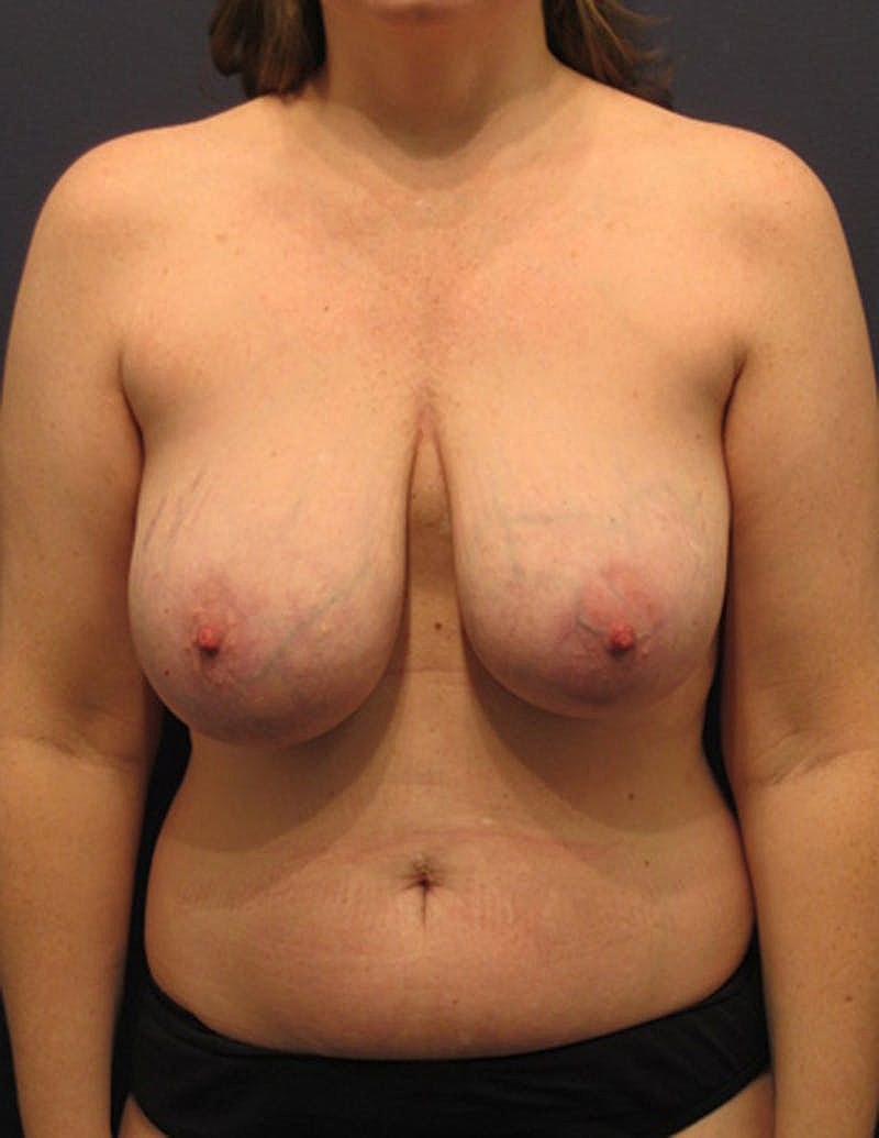 Mommy Makeover Before & After