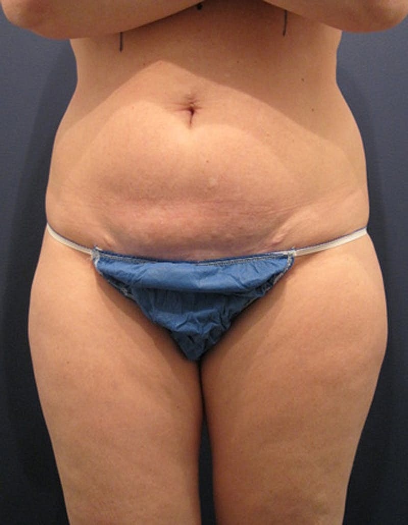 Mommy Makeover Before & After