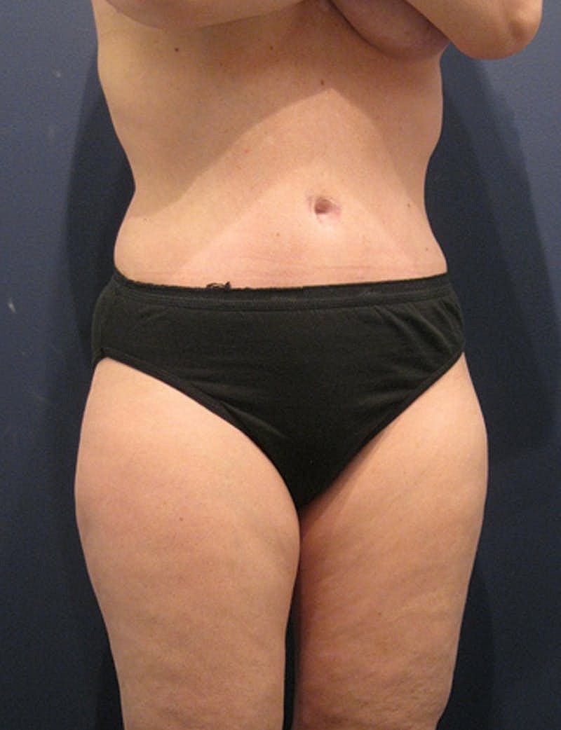 Mommy Makeover Before & After