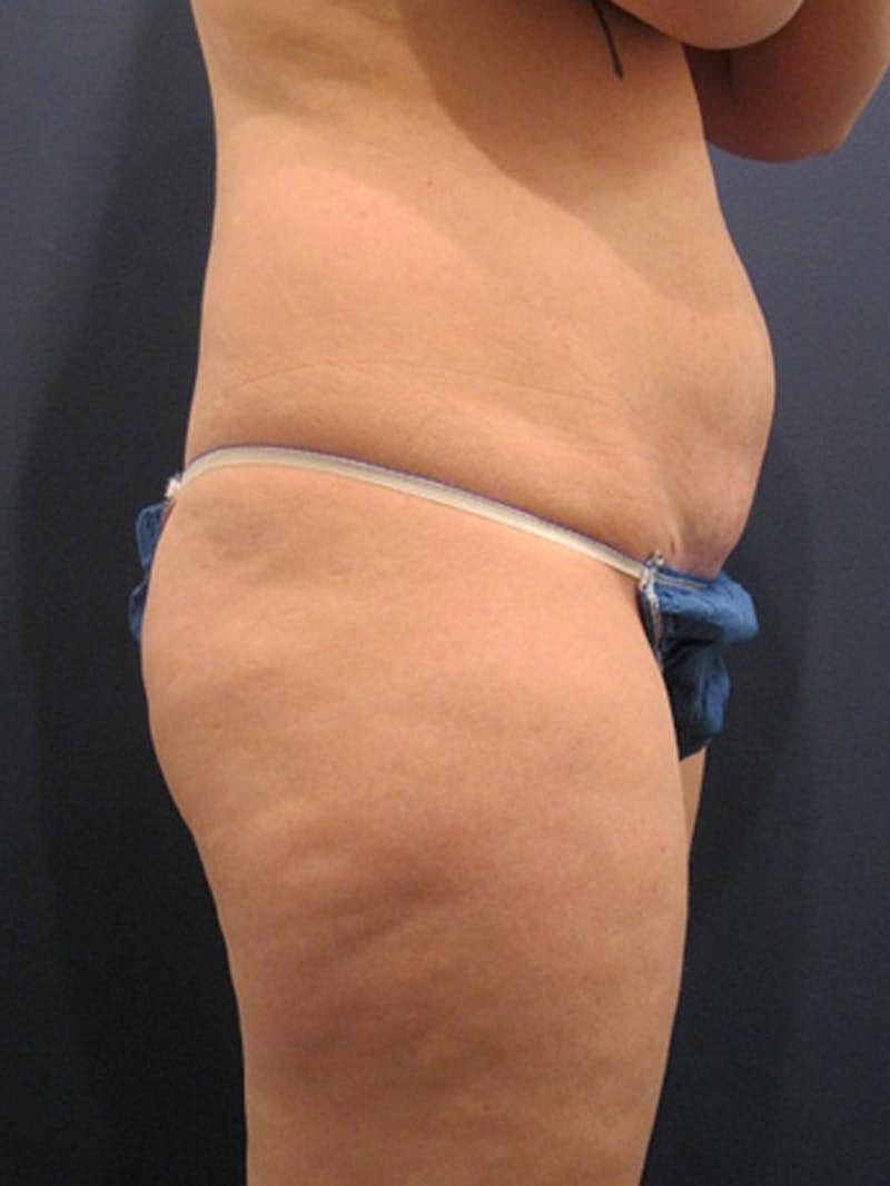 Mommy Makeover Before & After