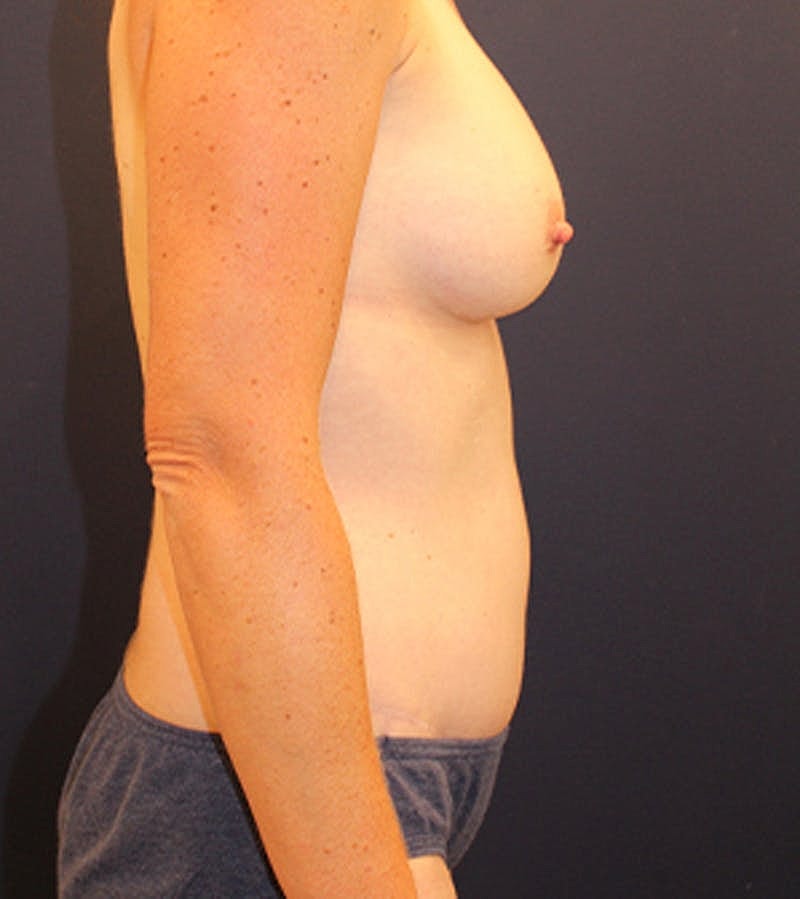 Mommy Makeover Before & After