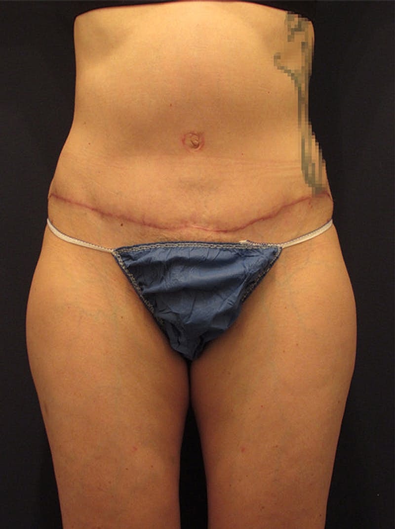 Mommy Makeover Before & After