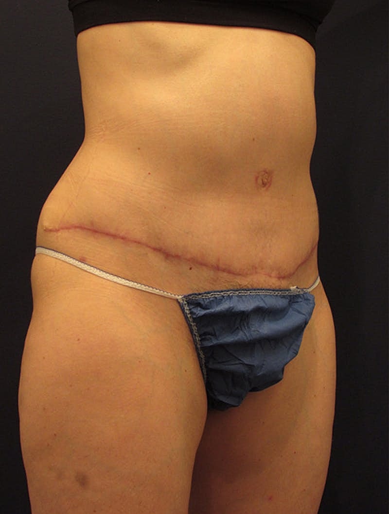 Mommy Makeover Before & After