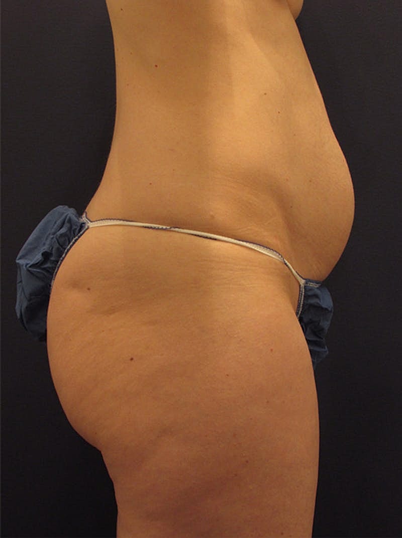 Mommy Makeover Before & After