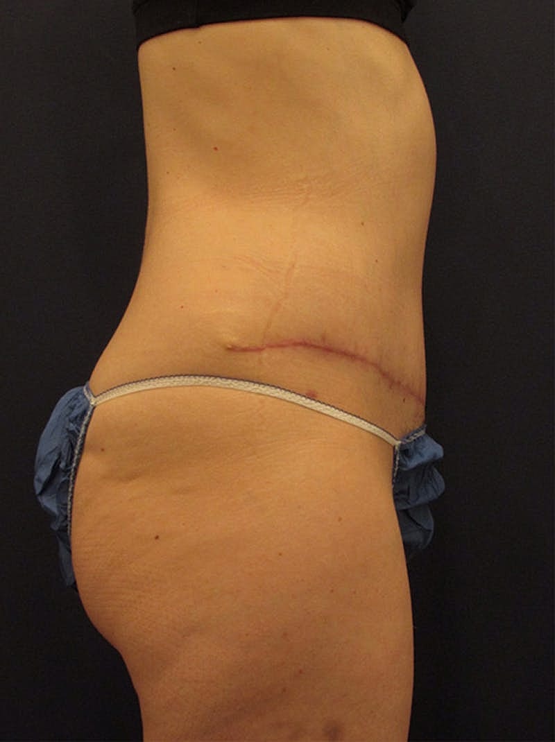 Mommy Makeover Before & After