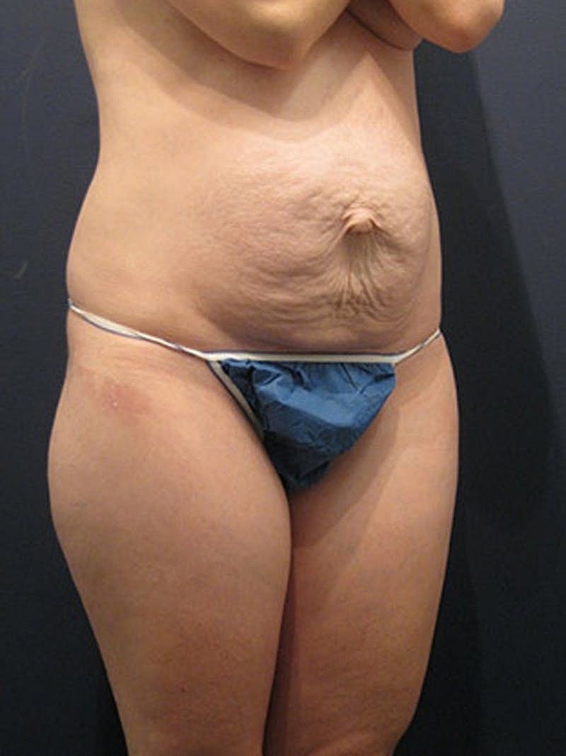 Mommy Makeover Before & After