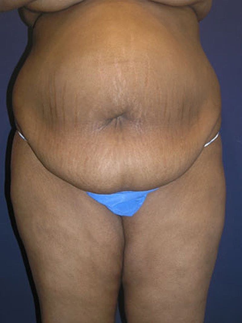 Mommy Makeover Before & After