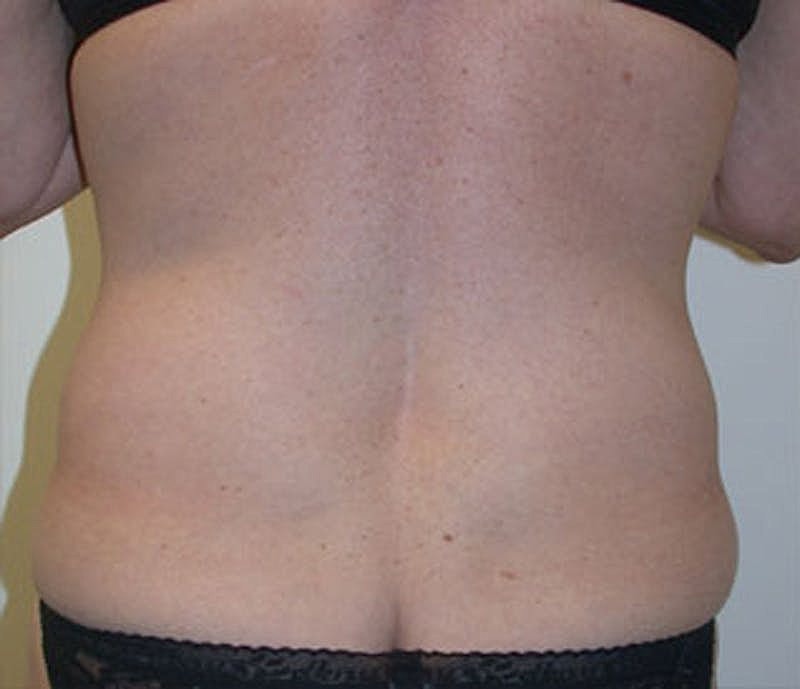 Mommy Makeover Before & After