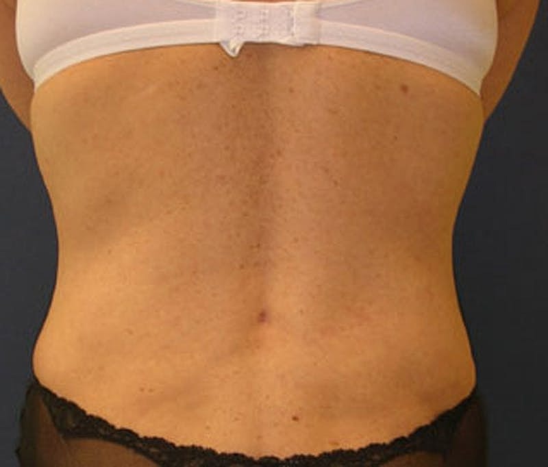 Mommy Makeover Before & After