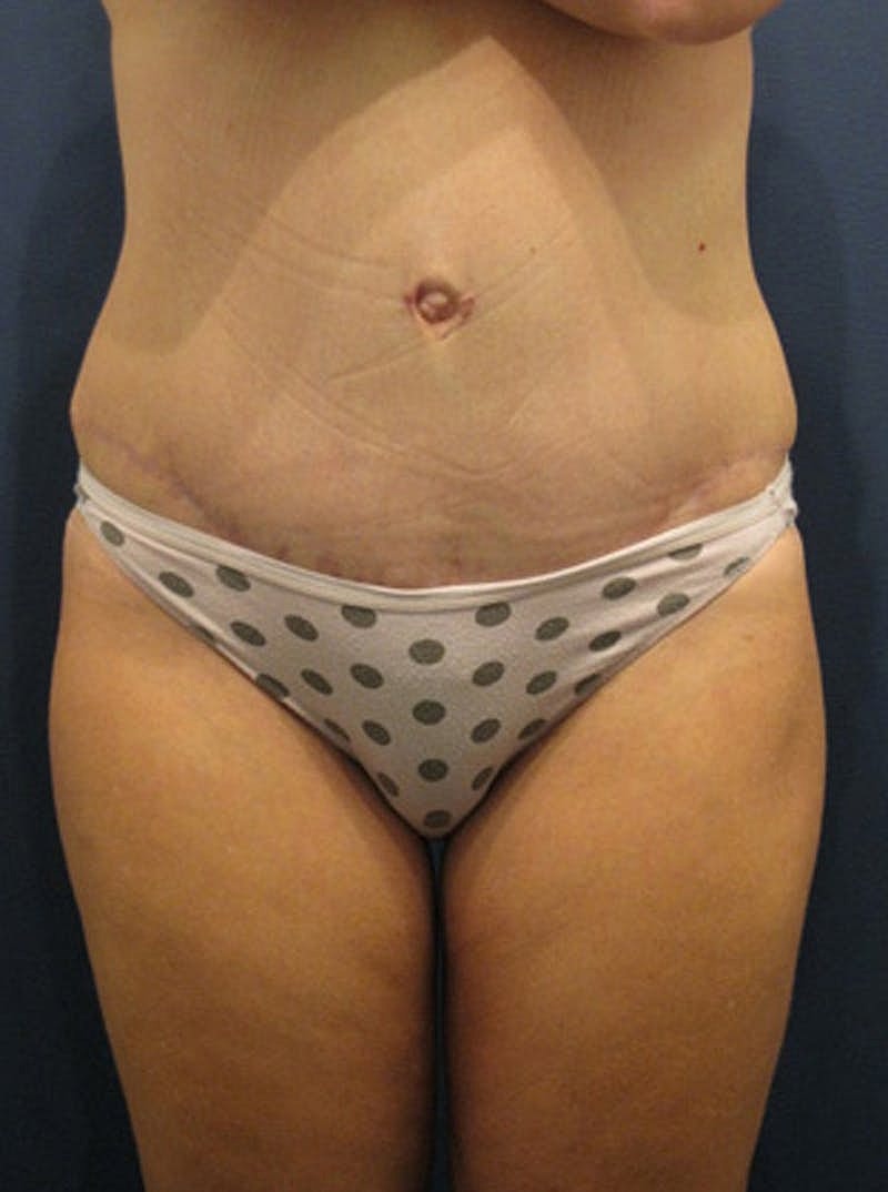 Mommy Makeover Before & After