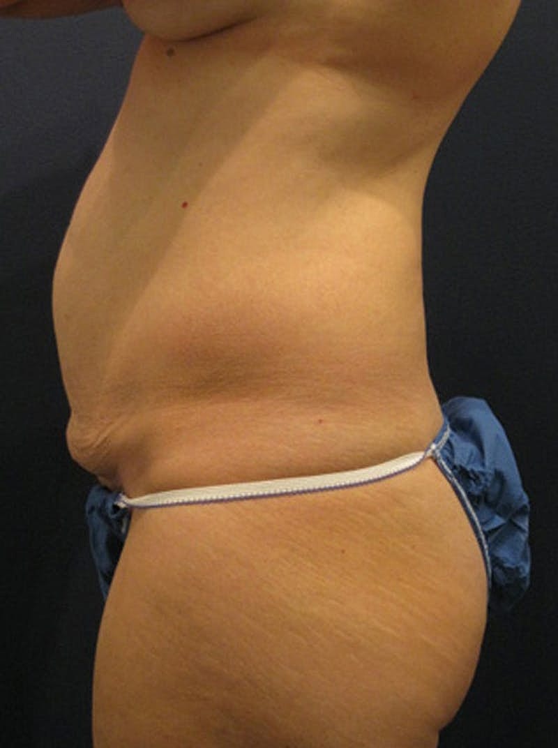 Mommy Makeover Before & After