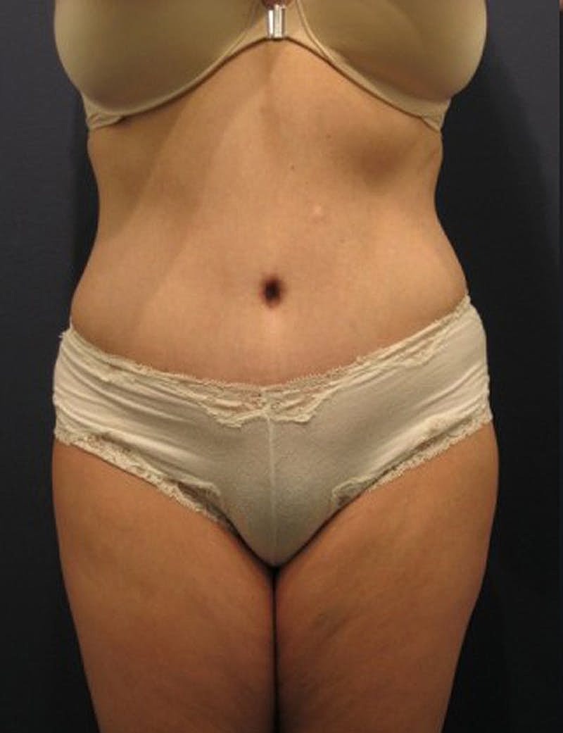 Mommy Makeover Before & After