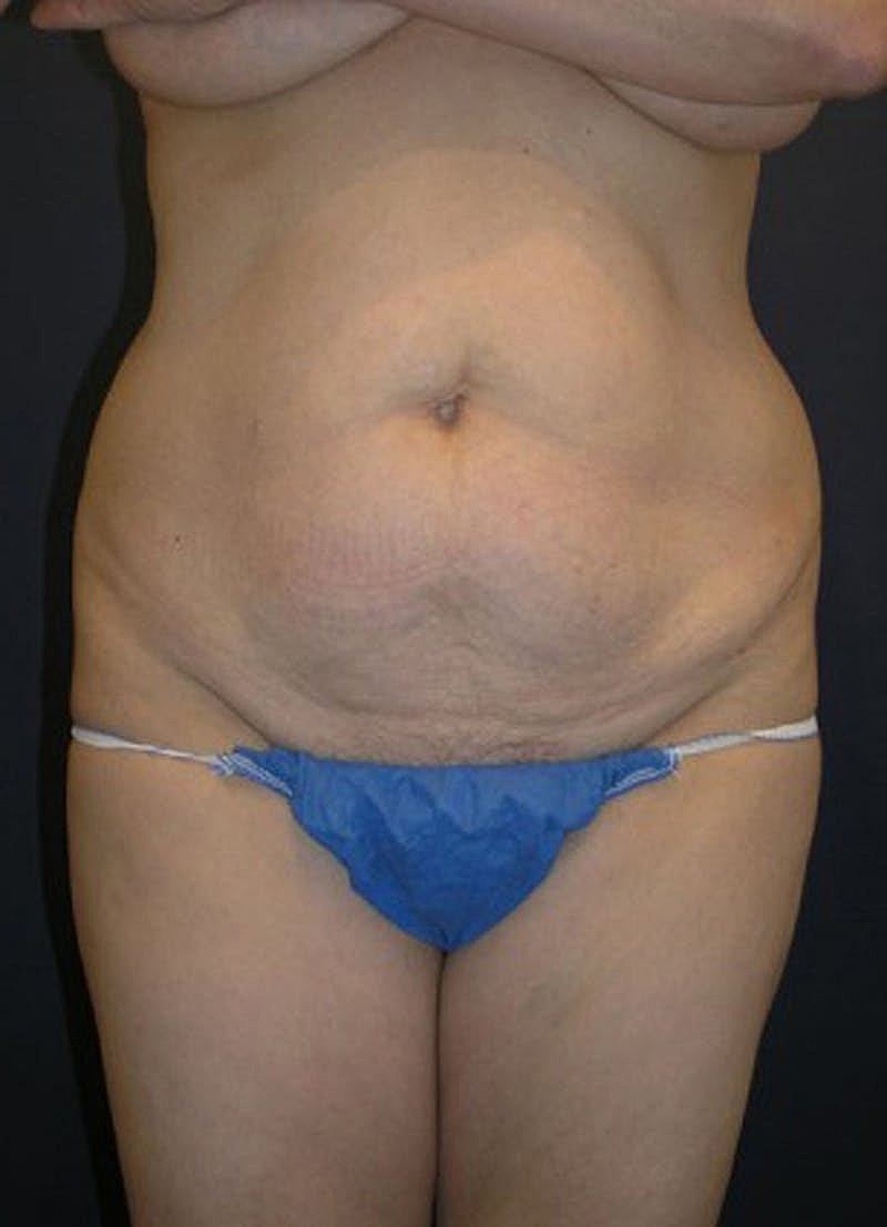 Mommy Makeover Before & After